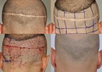 ForHair Hair Transplant Clinic image 8